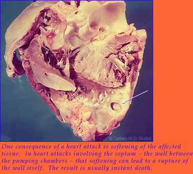 One consequence of a heart attack is the softening of the affected tissue.  In heart attacks involving the septum  the wall between the pumping chambers  that softening can lead to a rupture of the wall itself.  The result is usually instant death.