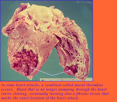 In some heart attacks, a condition called mural thrombus occurs.  Blood that is no longer pumping through the heart starts clotting, eventually turning into a fibrous tissue that marks the exact location of the heart attack.