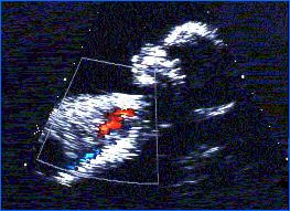 Fetal echocardiography