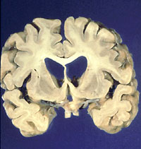 Huntington's Disease